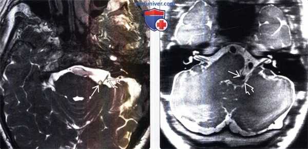 МРТ при гемифациальном спазме