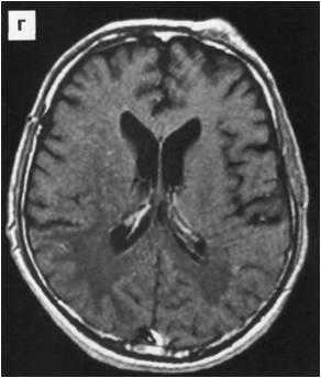 Поражение головного мозга при ВИЧ инфекции