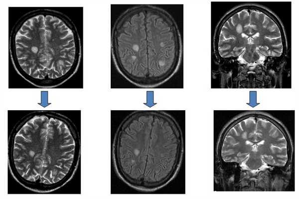 Поражение головного мозга при ВИЧ инфекции