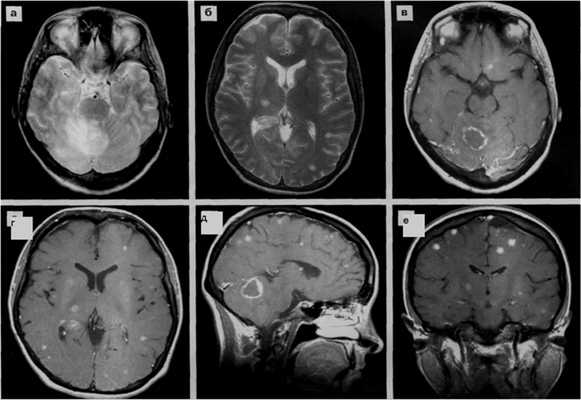 Поражение головного мозга при ВИЧ инфекции
