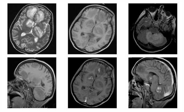 Поражение головного мозга при ВИЧ инфекции