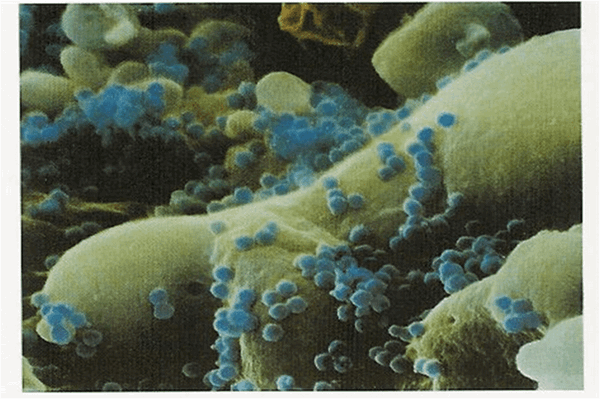 Поражение головного мозга при ВИЧ инфекции