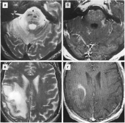 Поражение головного мозга при ВИЧ инфекции