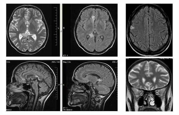 Поражение головного мозга при ВИЧ инфекции