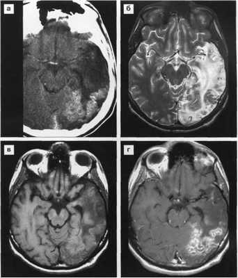Поражение головного мозга при ВИЧ инфекции