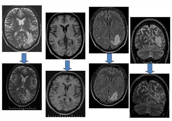 Поражение головного мозга при ВИЧ инфекции