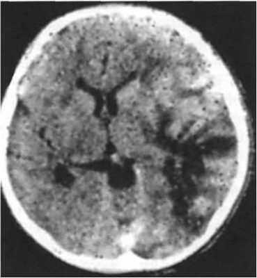 Поражение головного мозга при ВИЧ инфекции