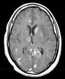 Токсоплазмоз на поперечной Т1-зависимой МРТ с контрастом