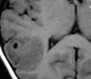 нейроцистицеркоз