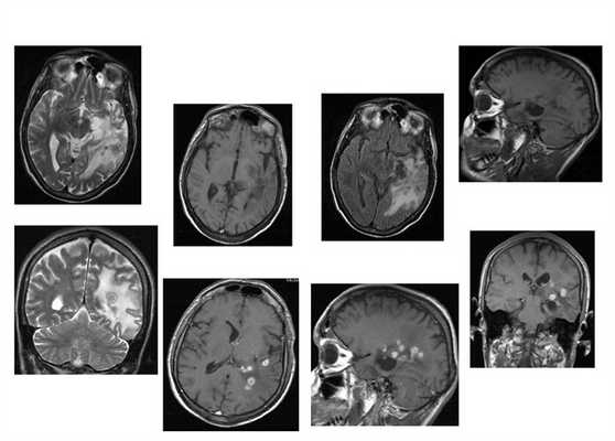 Поражение головного мозга при ВИЧ инфекции