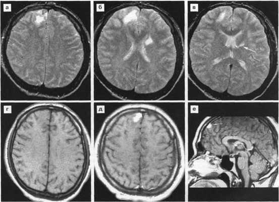 Поражение головного мозга при ВИЧ инфекции