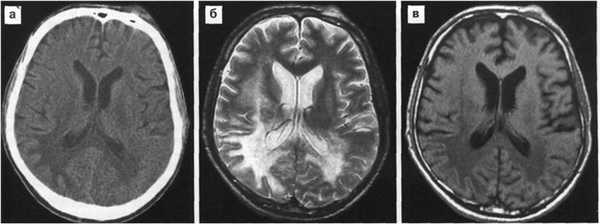 Поражение головного мозга при ВИЧ инфекции