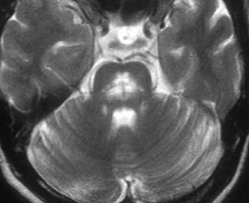 центральный понтинный миелиноз