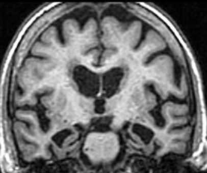 Альцгеймер