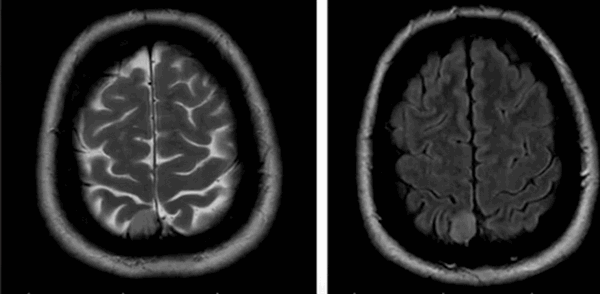 Менингиома на МРТ