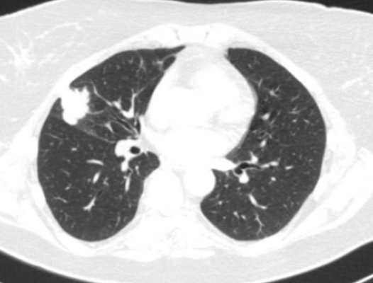 Периферический рак