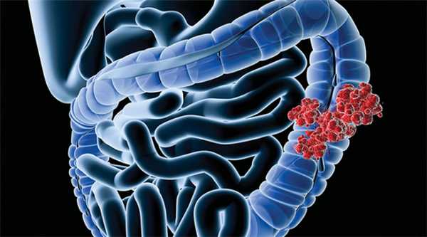 Опухоли толстого кишечника