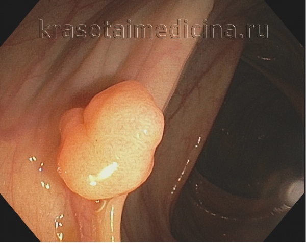 Рак ободочной кишки