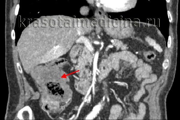 Рак толстой кишки