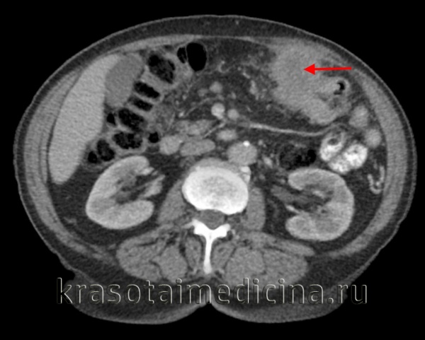 КТ ОБП. Опухоль поперечной ободочной кишки, прорастающая в переднюю брюшную стенку. (фото Вишняков В.Н.)