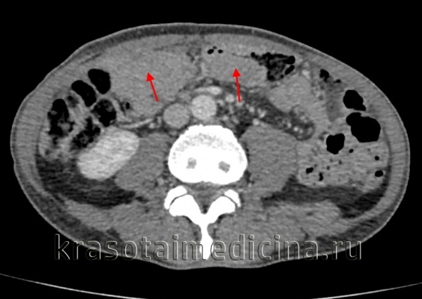 Рак толстой кишки