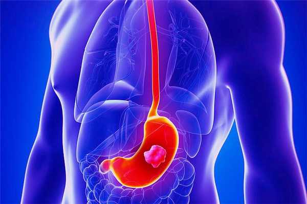 операция при раке желудка