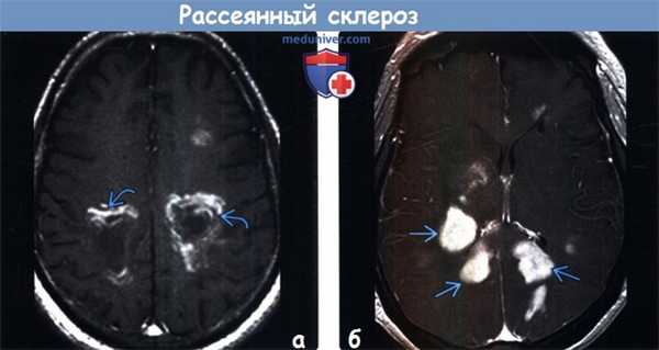 Рассеянный склероз на МРТ