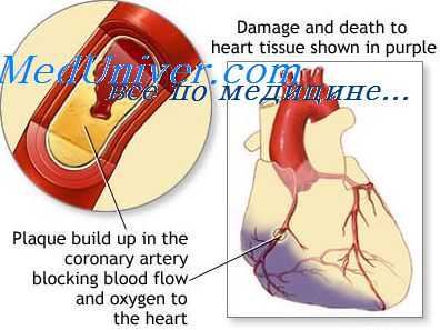 разрыв перегородки