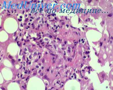 лечение ку-лихорадки