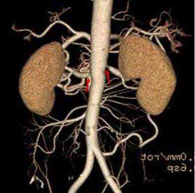 Стрелками обозначены участки сужения почечных артерий, выявленные на КТ