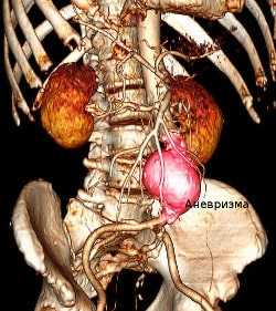 МСКТ аорты с контрастированием - лучший метод диагностики сосудов брюшной полости