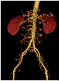 3D-реконструкция аорты - брюшной отдел и бифуркация