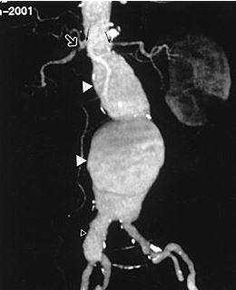 Аневризматические расширения брюшной аорты обозначены стрелками