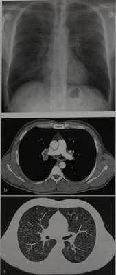 Снимки МРТ и КТ. Саркоидоз