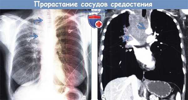 Прорастание (инвазия) сосудов средостения на рентгенограмме, КТ
