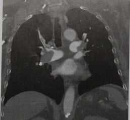 Снимки МРТ и КТ. Тромбоэмболия легочной артерии