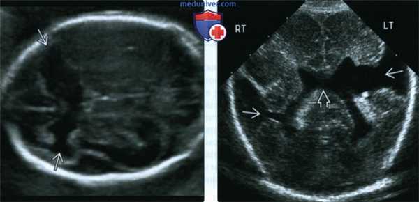 УЗИ, МРТ при шизэнцефалии у плода