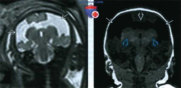 УЗИ, МРТ при шизэнцефалии у плода