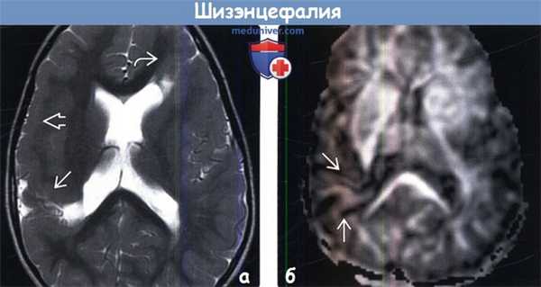 Шизэнцефалия на МРТ