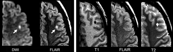 Картинки по запросу мрт ишемическая атака