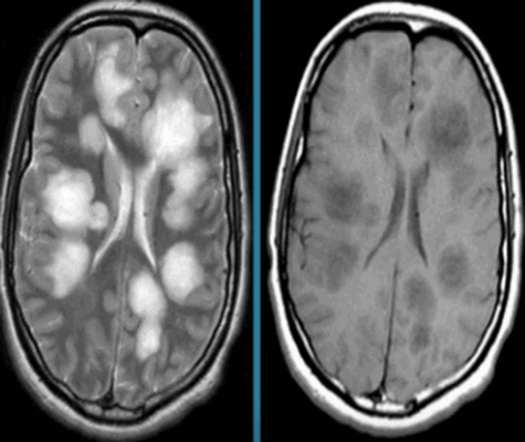 Острый рассеянный энцефаломиелит на МРТ