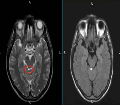 Липома четверохолмной цистерны на МРТ