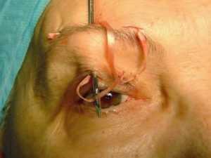 Оперативное подрезание век