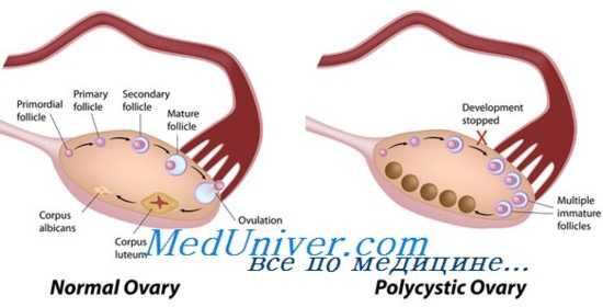 поликистоз яичника