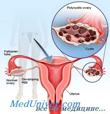 синдром склерокистозных яичников