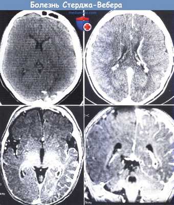 Болезнь Стерджа-Вебера