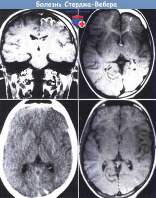 Болезнь Стерджа-Вебера