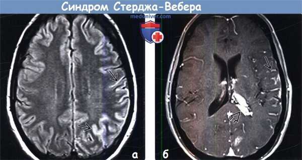 Синдром Стерджа-Вебера на МРТ