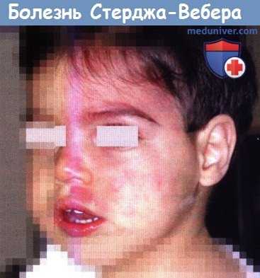 Болезнь Стерджа-Вебера