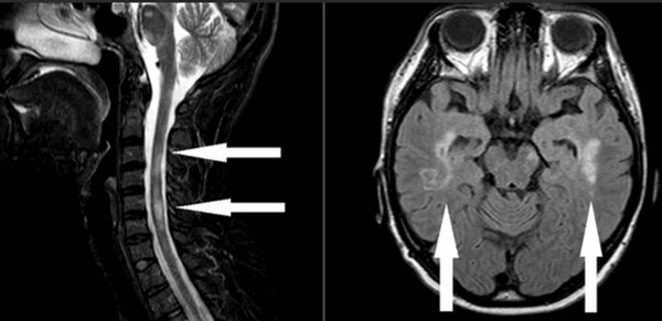 демиелинизация нервных волокон на МРТ